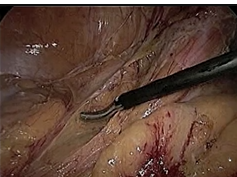 SAGES Pearls Session: Laparoscopic Sigmoid Colectomy - Tonia Young-Fadok SAGES Pearls Session: Laparoscopic Sigmoid Colectomy - Tonia Young-Fadok