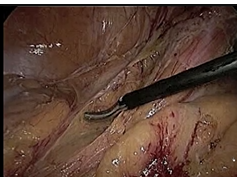 Sages Pearls Session: Laparoscopic Sigmoid Colectomy - Tonia Young-Fadok