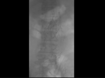 Salvage of a Fractured Endologix Stent Graft Salvage of a Fractured Endologix Stent Graft