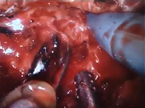 SALVAGE ROBOT-ASSISTED LAPAROSCOPIC PROSTATECTOMY