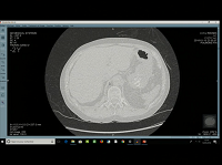 Savoir regarder le cur en TDM thoracique
