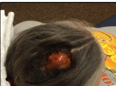 Scalp abscess drainage
