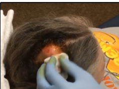 Scalp Abscess Treated by Dr. ER