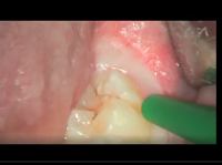 Schneiderian Membrane perforation Management