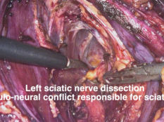 Sciatic nerve conflict responsible for sciatic pain: full time procedure