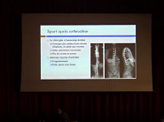 Scoliose de lenfant et sport