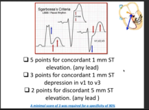 Sgarbossa - LBBB with MI ECG