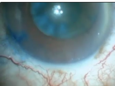 Shortening a Long Clear Corneal Incision Shortening a Long Clear Corneal Incision