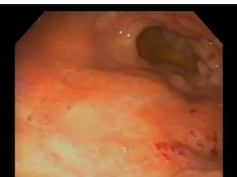 Signet Ring Gastric Cancer of Remnant Stomach Following Gastric Bypass
