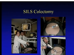 Simulation Training for Laparoscopic Colon Resection Simulation Training for Laparoscopic Colon Resection