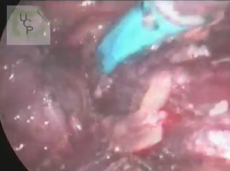 Simultaneous Laparoscopic Rectosigmoidectomy & TAMIS For Synchronous Colorectal Tumours Simultaneous Laparoscopic Rectosigmoidectomy & TAMIS For Synchronous Colorectal Tumours