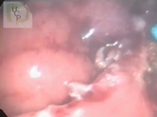 Simultaneous Laparoscopic Rectosigmoidectomy & TAMIS For Synchronous Colorectal Tumours Simultaneous Laparoscopic Rectosigmoidectomy & TAMIS For Synchronous Colorectal Tumours
