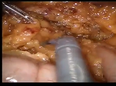 Simultaneous Robotic TME + Radical Prostatectomy & Iliac Lymphadenectomy for Synchronous Cancers Simultaneous Robotic TME + Radical Prostatectomy & Iliac Lymphadenectomy for Synchronous Cancers