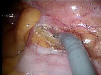 Single Dock Totally Robotic Total Mesorectal Excision