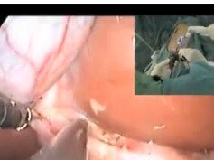 Single Incision Laparoscopic Cholecystectomy : One Hand Technique