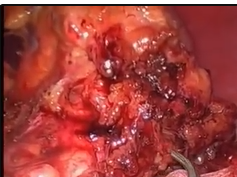 Single Incision Laparoscopic Distal Pancreatectomy With Splenectomy - Operative Video Single Incision Laparoscopic Distal Pancreatectomy With Splenectomy - Operative Video