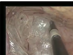 Single Incision Laparoscopic Rectosigmoid Resection and Rectoplexy for Rectal Prolapse Single Incision Laparoscopic Rectosigmoid Resection and Rectoplexy for Rectal Prolapse