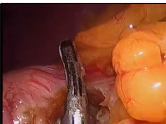 Single Incision Laparoscopic Sutured Exogastric Cystogastrostomy Operative Video Single Incision Laparoscopic Sutured Exogastric Cystogastrostomy Operative Video