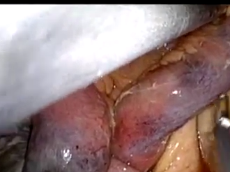 Single Incision Laparoscopy in a Hostile World