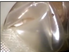 Single Port Cholecystectomy