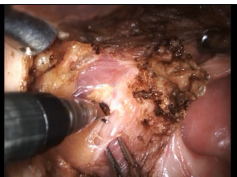 Single-Port Robotic Head and Neck Surgery