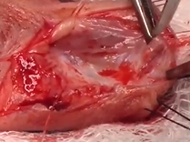 Single-Stage Reconstruction of Fossa Navicularis Strictures Using A Sliding-T