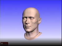 Sinus lift 3D / Antrostomy
