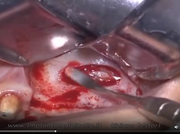 Sinus lift - Antrostomy