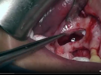 Sinus surgery: lateral approach