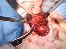 Sistrunk Procedure for Excision of a Thyroglossal Duct Cyst