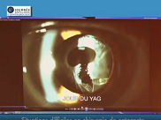 Situations difficiles en chirurgie de cataracte
