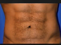 Six-Pack Surgery. Plastic Surgery Hot Topics with Rod J. Rohrich, MD