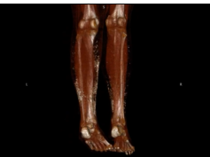 Skin Calcification From Graft-Versus-Host Disease