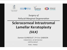 Slerocorneal Intrastromal Lamellar Keratoplasty for Pellucid Marginal Degeneration: A New Surgical Technique Slerocorneal Intrastromal Lamellar Keratoplasty for Pellucid Marginal Degeneration: A New Surgical Technique
