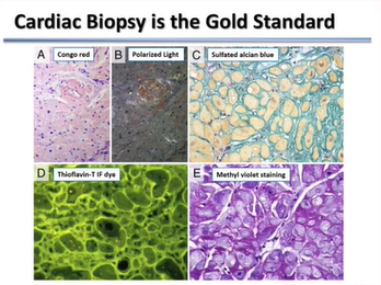 SLIDES ONLY Emerging Therapies for the Treatment of Cardiac Amyloidosis
