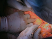 SMA Embolectomy SMA Embolectomy