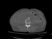SMA Exposure, Thromboembolectomy, Patch Angioplasty and Retrograde Stenting SMA Exposure, Thromboembolectomy, Patch Angioplasty and Retrograde Stenting