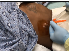 Small Abscess Drained - Cysts, Pimples & Popping!