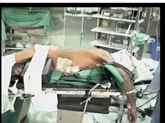 SS03 Best Of Video I V003. LAPAROSCOPIC ESOPHAGO-GASTRECTOMY WITH COLONIC INTERPOSITION SS03 Best Of Video I V003. LAPAROSCOPIC ESOPHAGO-GASTRECTOMY WITH COLONIC INTERPOSITION