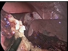 SS17 Solid Organ: S100 IMPACT OF POSTERIOR RETROPERITONEOSCOPIC ADRENALECTOMY IN CARE CENTER SS17 Solid Organ: S100 IMPACT OF POSTERIOR RETROPERITONEOSCOPIC ADRENALECTOMY IN CARE CENTER