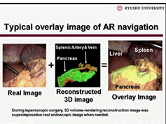 SS17 Solid Organ: S102 AUGMENTED REALITY NAVIGATION SYSTEM FOR LAPAROSCOPIC SPLENECTOMY SS17 Solid Organ: S102 AUGMENTED REALITY NAVIGATION SYSTEM FOR LAPAROSCOPIC SPLENECTOMY