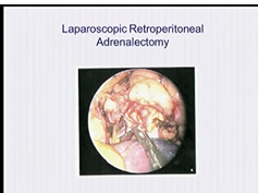 SS17 Solid Organ: V042 SINGLE-ACCESS TRANSUMBILICAL LAPAROSCOPIC SPLENECTOMY
