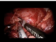 SS17 Solid Organ: V043 ROBOT-ASSISTED TRANSAXILLARY HEMI-THYROIDECTOMY