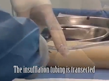 Stable Pneumorectum by Inline Glove (SPRING) A Cost-Effective Technique Facilitating taTME Stable Pneumorectum by Inline Glove (SPRING) A Cost-Effective Technique Facilitating taTME