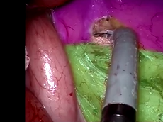 Standardised Approach For Complete Mobilisation Of Splenic Flexure During Robotic Rectal Surgery Standardised Approach For Complete Mobilisation Of Splenic Flexure During Robotic Rectal Surgery