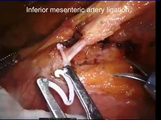Standardized Approach in Robotic Abdominoperineal Resection