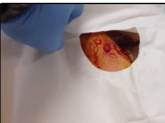 Staph Infection? Abscess Core Removal
