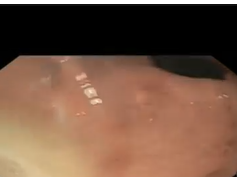 Staple Line Breakdown after Sleeve Gastrectomy