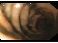 Staple Line Leak after Sleeve Gastrectomy - 2