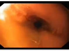 Staple Line Leak after Sleeve Gastrectomy - 3